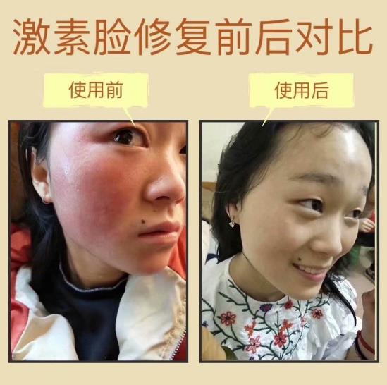 激素臉越來越嚴重了怎么辦?調理激素臉的好方法【值得收藏】
