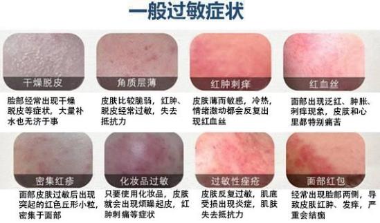 臉過敏癥狀有哪些?臉上過敏發紅發癢怎么辦?