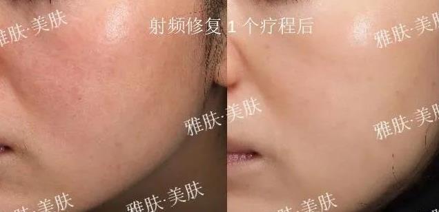 叮咚~雅膚給您推送了敏感肌護理必備指南,請查收