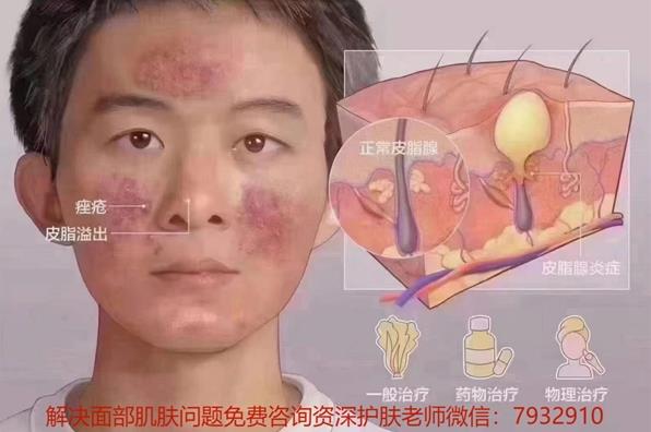 朵嘉濃護膚品祛痘效果好?祛痘痘方法真實案例分享