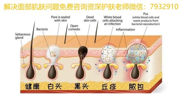 朵嘉濃護膚品祛痘效果好?祛痘痘方法真實案例分享