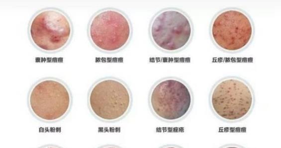 祛痘產(chǎn)品哪個好?朵嘉濃護膚品是專業(yè)祛痘必不可少的法寶