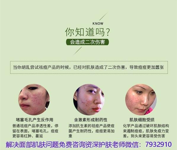 祛痘護膚有什么比較好的產品推薦?朵嘉濃祛痘凝膠