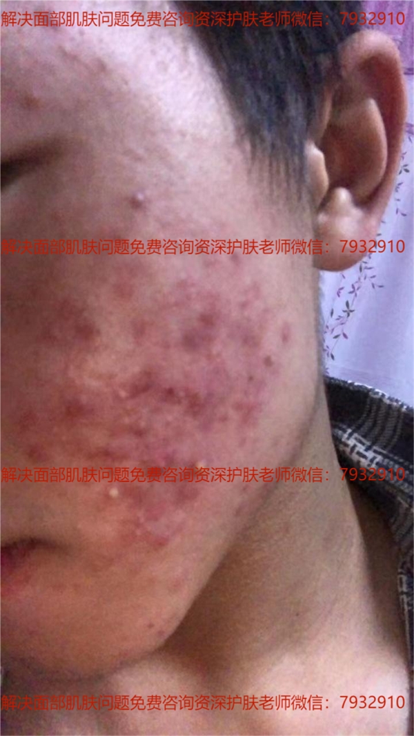 朵嘉濃護膚品祛痘效果好?祛痘痘方法真實案例分享