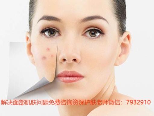 祛痘痘印真的不難,祛痘護(hù)膚品我只用朵嘉濃