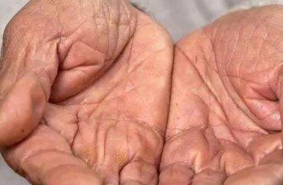 手部脫皮很難看 介紹改善手部脫皮的6個妙方