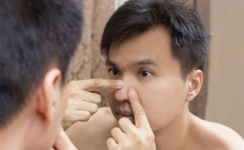 臉上為什么會長粉刺呢 正確去除粉刺的方法