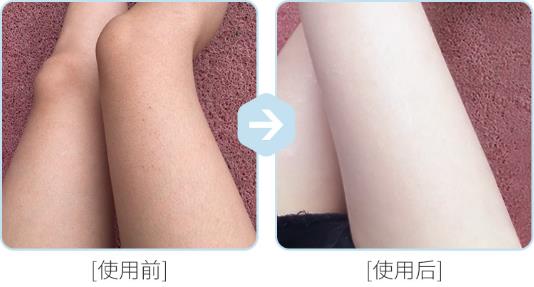 腿上雞皮膚怎么消除最有效 三種簡(jiǎn)單又實(shí)用的方法
