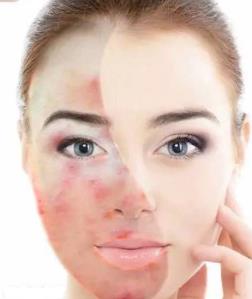 如何治療激素臉,激素臉排毒如何修復