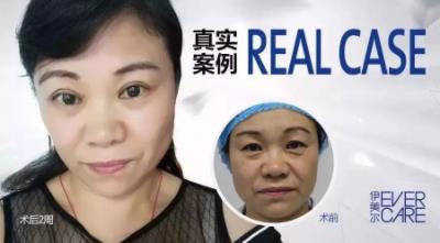 北京伊美爾楊紅巖醫(yī)生怎么樣?