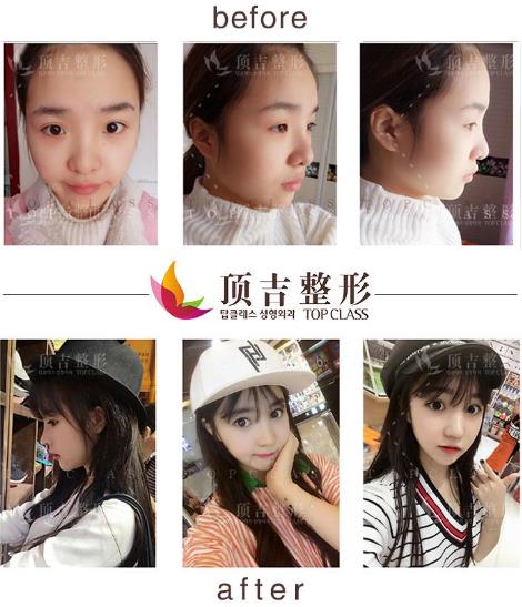 武漢頂吉整形鼻修復有優勢嗎 為你定制天姿美鼻