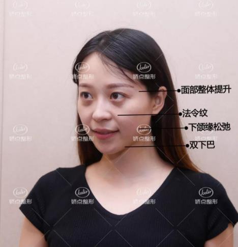 成都嬌點整形胡浪熱提拉:不被年齡限制 活出自己想要的精彩