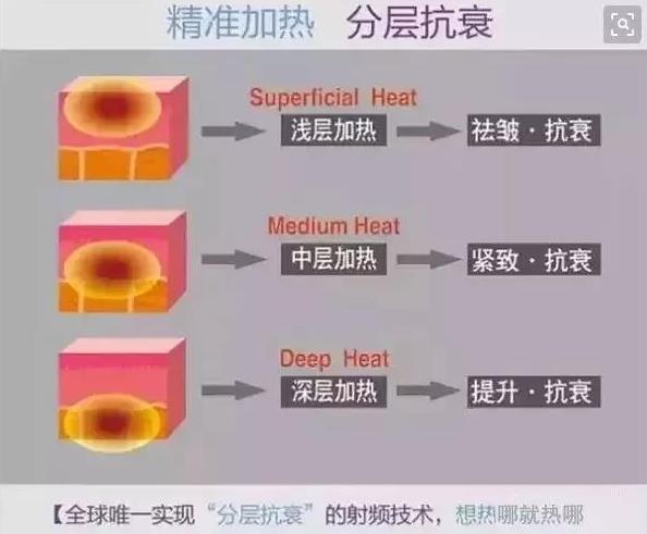 成都嬌點整形胡浪熱提拉:不被年齡限制 活出自己想要的精彩
