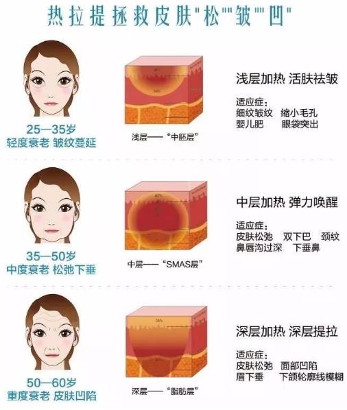 成都嬌點整形胡浪熱提拉:不被年齡限制 活出自己想要的精彩