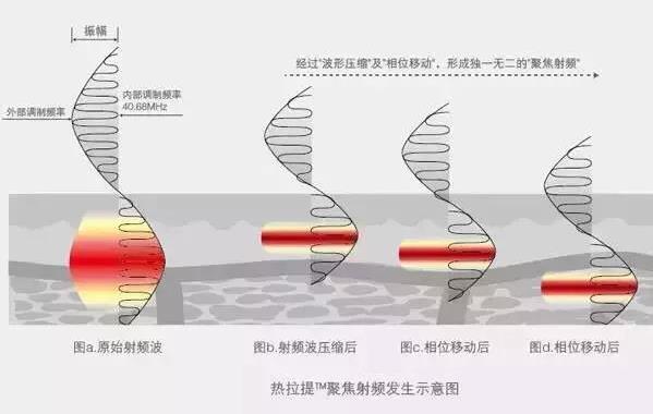成都嬌點整形胡浪熱提拉:不被年齡限制 活出自己想要的精彩