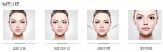 北京伊美爾醫療醫院:肉毒素多少錢