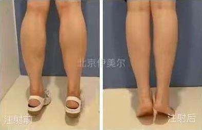北京伊美爾醫療醫院:肉毒素多少錢