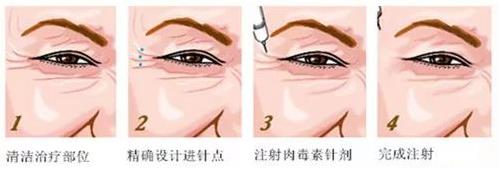 北京伊美爾醫療醫院:肉毒素多少錢