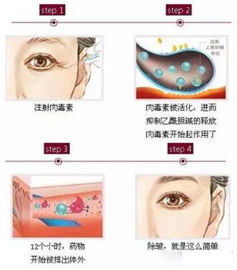 北京伊美爾醫療醫院:肉毒素多少錢