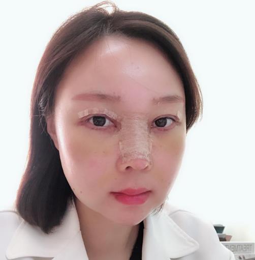 青島華韓整形美容醫院員工體驗 面部填充 隆鼻和美眼術