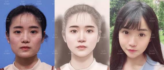 成都嬌點整形下頜角 曲線截骨術前術后對比