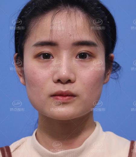 成都嬌點整形下頜角 曲線截骨術前術后對比