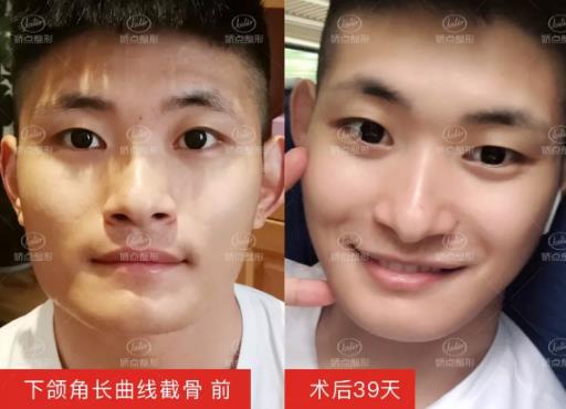 成都嬌點整形下頜角 曲線截骨術前術后對比