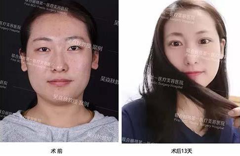 聯合麗格第一醫院:做雙眼皮手術是全切還是埋線