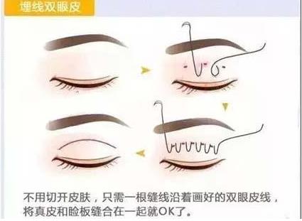 聯合麗格第一醫院:做雙眼皮手術是全切還是埋線