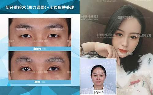 聯合麗格第一醫院:做雙眼皮手術是全切還是埋線