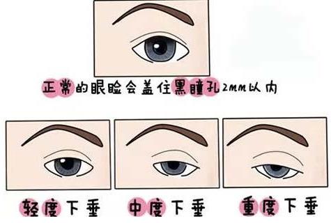 聯合麗格第一醫院:做雙眼皮手術是全切還是埋線