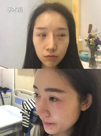 福州米蘭整形隆鼻好嗎 重視健康用心呵護(hù)