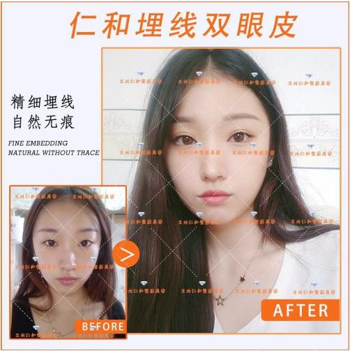 蘭州仁和整形埋線雙眼皮好不好 品質口碑讓你安全變美