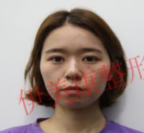 凹陷皺紋臉上掛,脂肪填充不害怕,黃元生面部脂肪填充輕松搞定