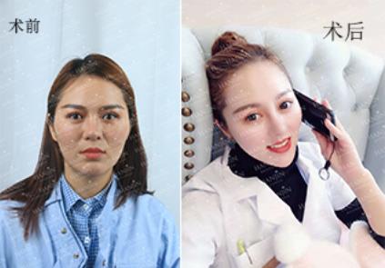 昆明韓辰自體脂肪填充怎么樣 高成活 立現少女臉