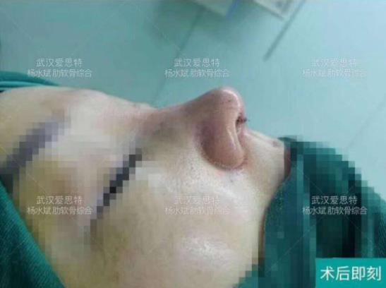 武漢愛思特楊水斌隆鼻價格貴不?