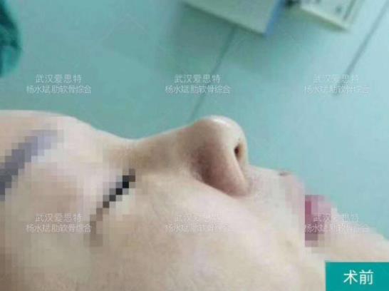 武漢愛思特楊水斌隆鼻價格貴不?