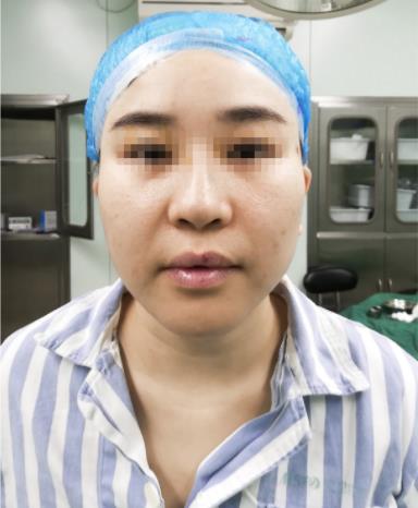 武漢愛思特楊水斌隆鼻價格貴不?