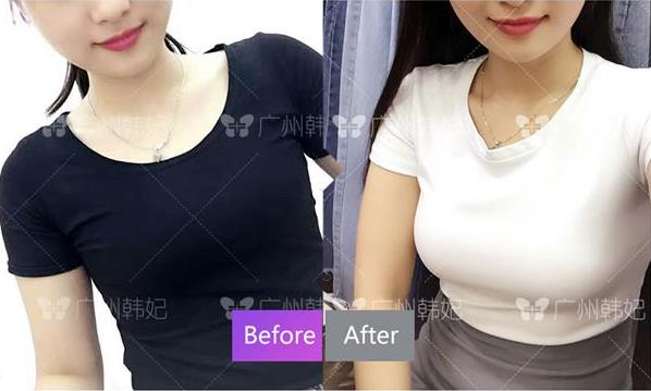 廣州韓妃整形專家楊德發(fā),20年專研探索女人弧度之美