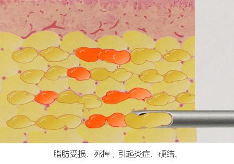 面部填充失敗的原因是什么?又該如何修復?韋元強分析