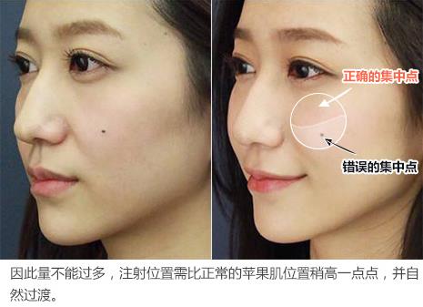 面部填充失敗的原因是什么?又該如何修復?韋元強分析