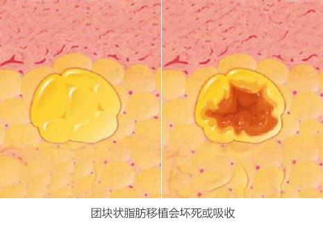 面部填充失敗的原因是什么?又該如何修復?韋元強分析