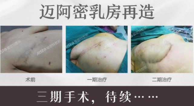 愛(ài)思特張敏邁阿密乳房再造口碑如何,有案例嗎?