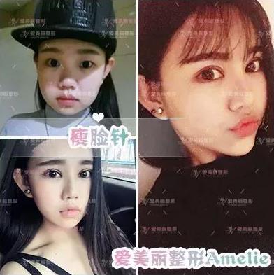 鄭州愛美麗醫院,有一種肉毒素,打了“它”,男友比原來更加愛你了!
