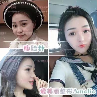 鄭州愛美麗醫院,有一種肉毒素,打了“它”,男友比原來更加愛你了!