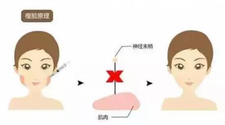 鄭州愛美麗醫院,有一種肉毒素,打了“它”,男友比原來更加愛你了!