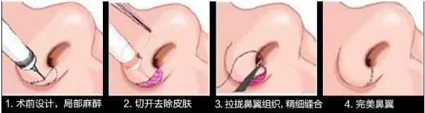 北京煤醫整形醫院王馳主任:鼻翼整形你了解多少