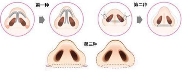 北京煤醫整形醫院王馳主任:鼻翼整形你了解多少