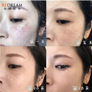 寧波薇琳整形醫(yī)院祛斑好嗎?讓你重獲年輕靚麗
