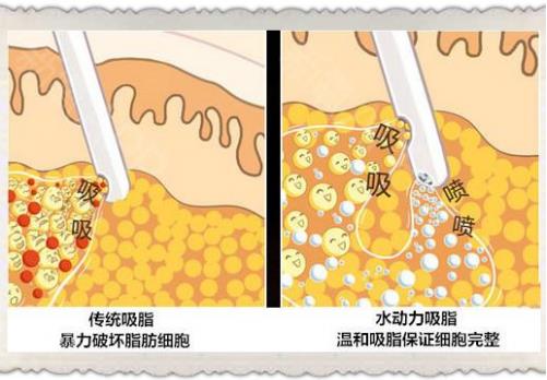 北京常好麗格黃貞院長解析:面部吸脂適合哪些人群?